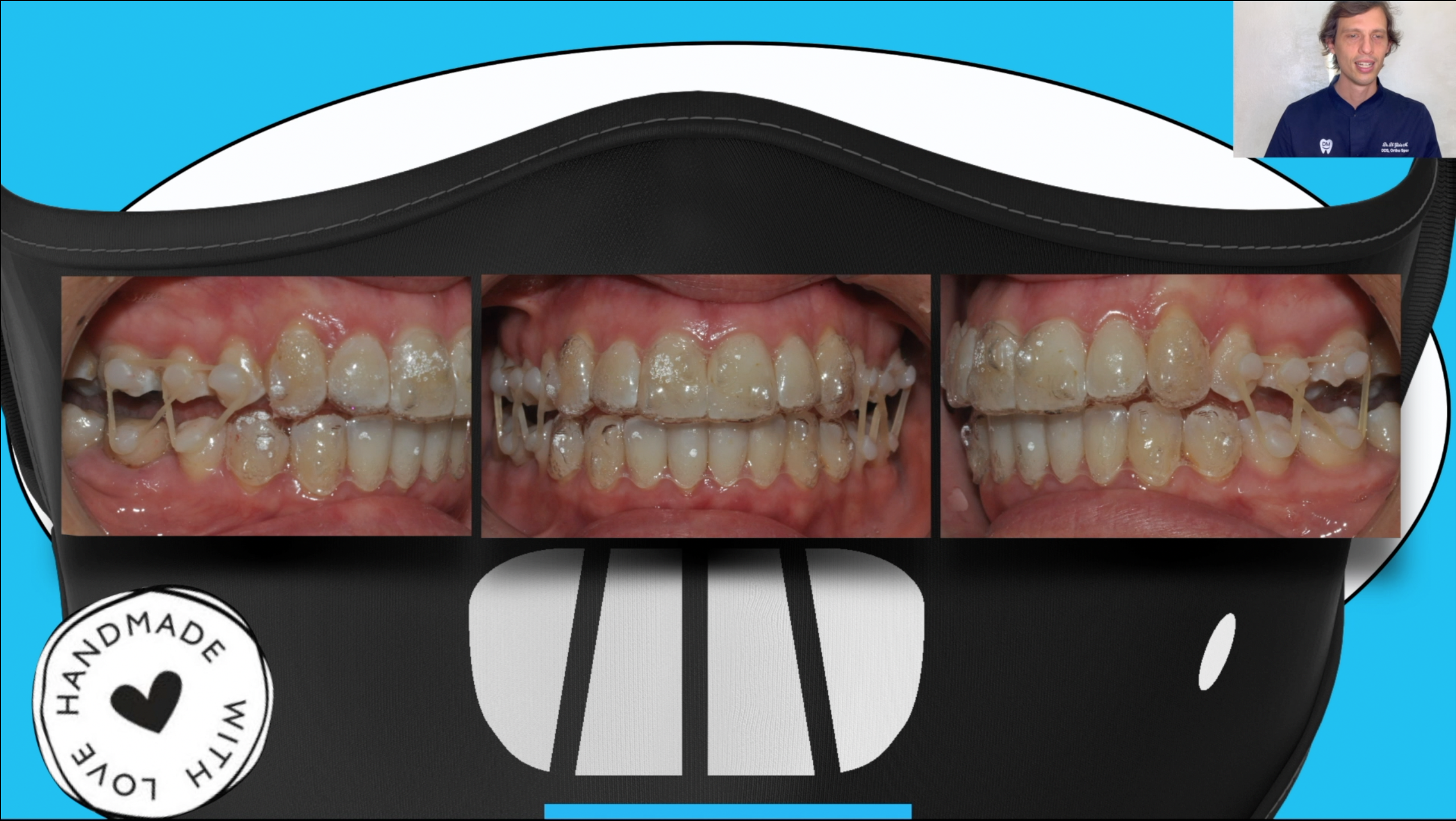 Tecnica Ortodontica con Allineatori - Clinicadrm