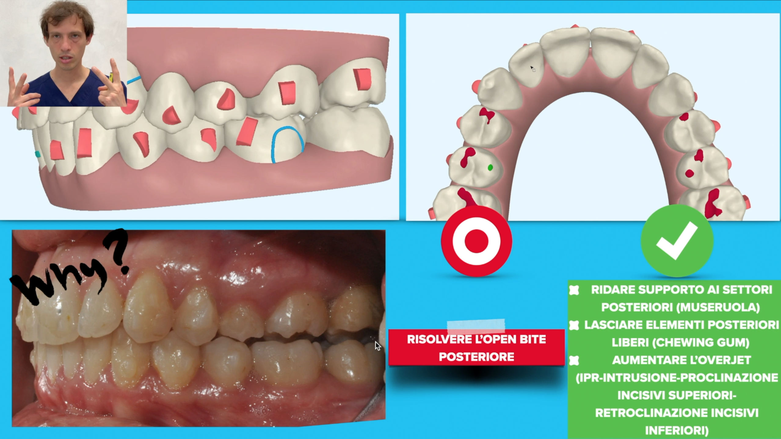 Ortodonzia Dentale Allineatore Invisibile Kit 3 Pezzi Correzione del morso  Bretelle da Masticare Denti per la Cura Orale Domestico(Rosso) : :  Salute e cura della persona