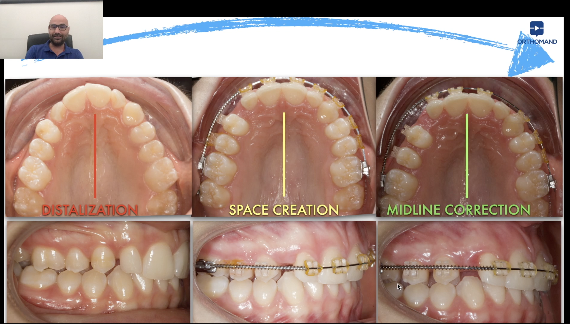 DISTALIZZAZIONE MOLARE LESS IS MORE - Orthomand