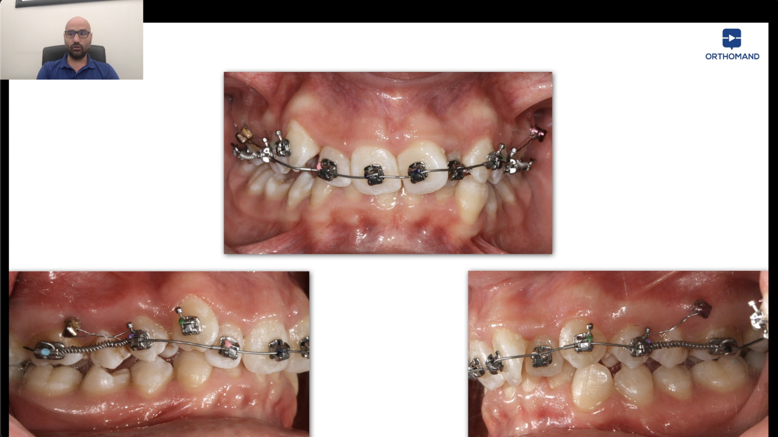 Miniviti Ortodontiche (TADs) Nell'ortodonzia Degli Adulti • My FACE Expert - Foto 3
